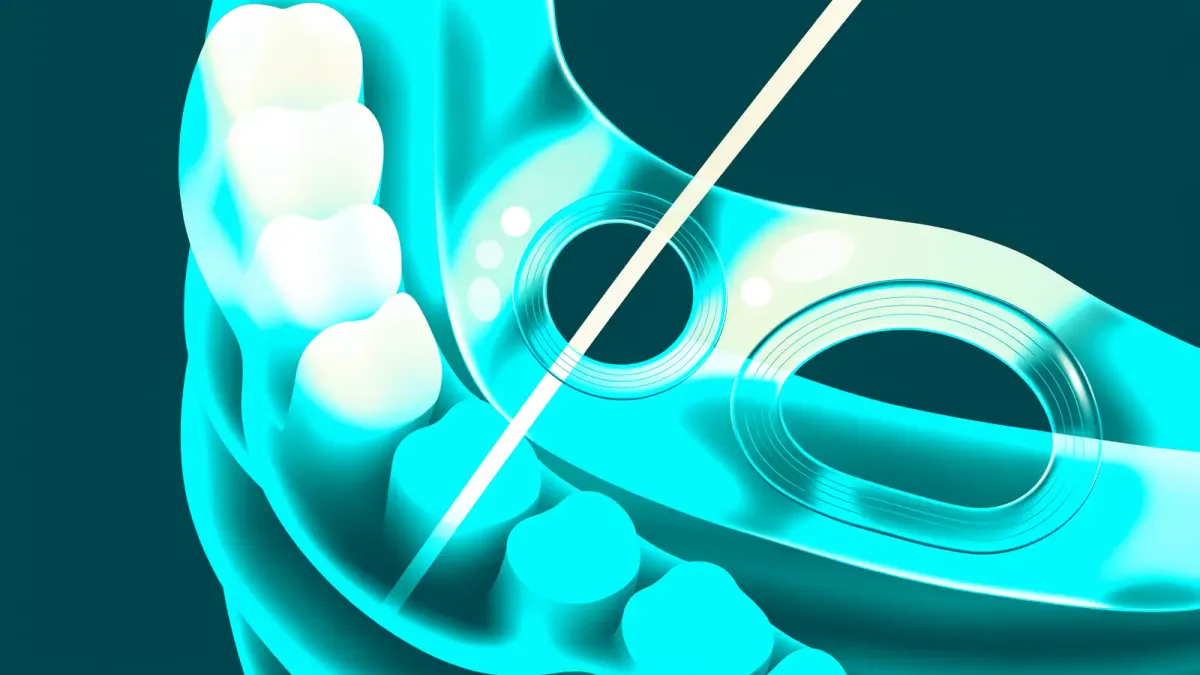 Clinician reviewing a 3D implant plan on software with a surgical guide and CBCT scan on screen