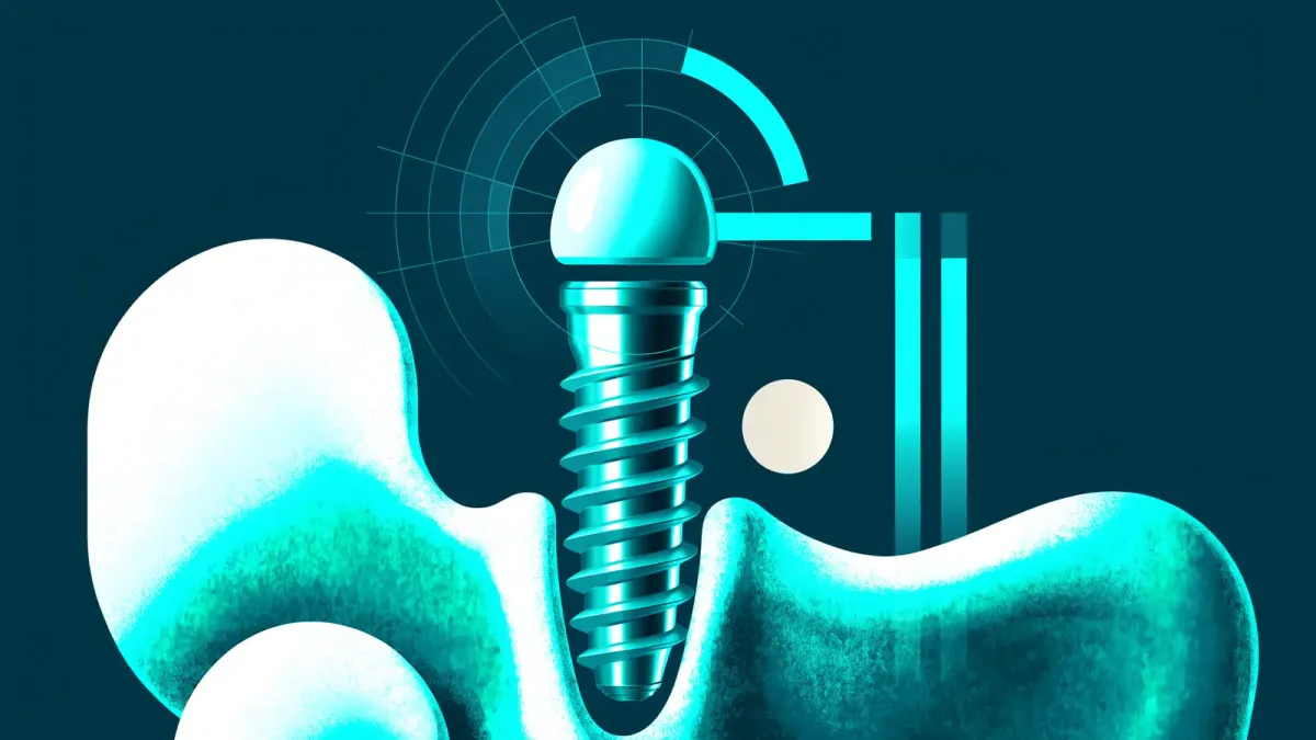 Nobel Biocare S Series implant components displayed alongside a DTX Studio treatment plan on a monitor