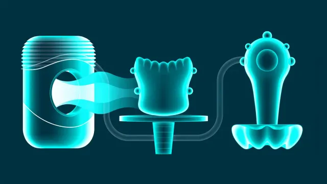 Straumann BLX implant and digital planning software displayed on a dental workstation monitor